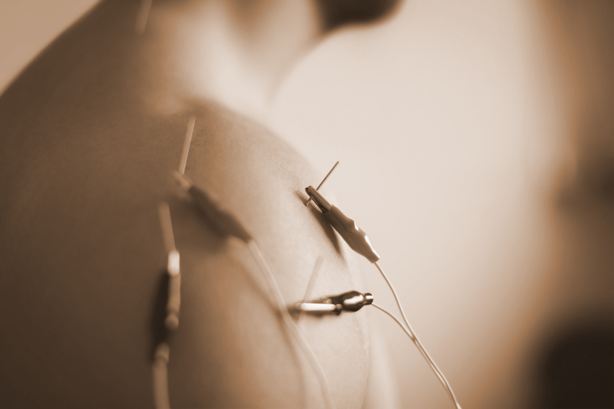 neuromodulación invasiva 